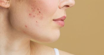 Woman with a little acne