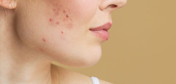 Woman with a little acne